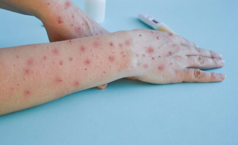 Ante casos de viruela del mono, PRI urge a Salud implementar campaña de prevención