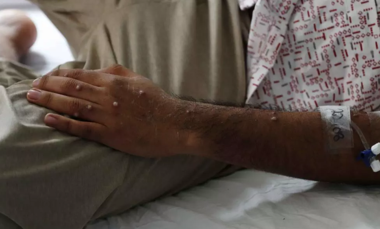 Viruela del Mono: Síntomas y cómo se contagia