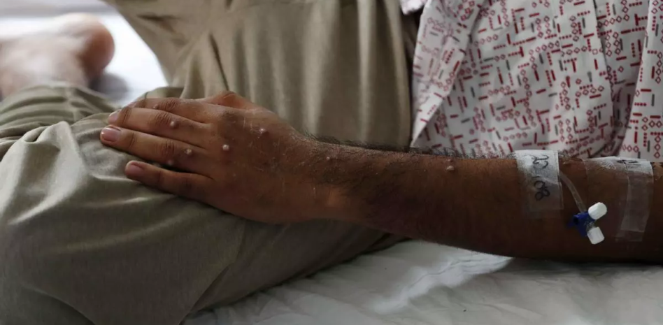 Viruela del Mono: Síntomas y cómo se contagia